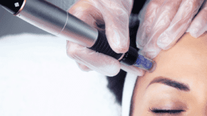 simply clinics blog microneedling