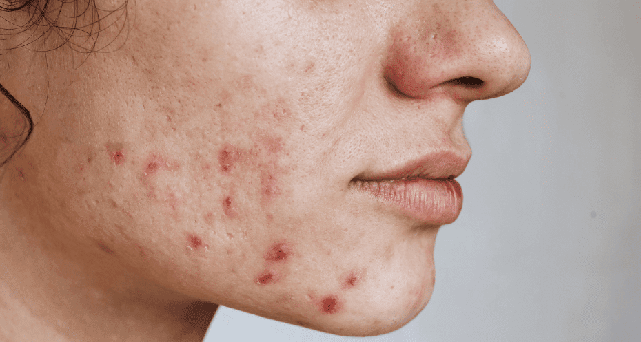 acne treatment blog simply clinics