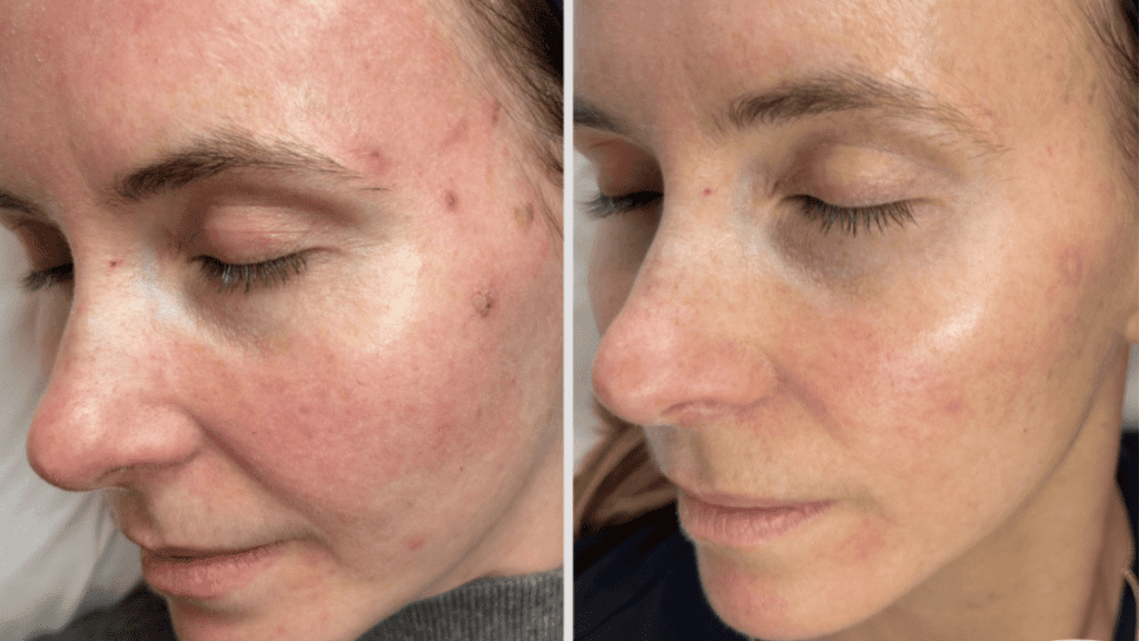 salmon sperm facial: exosomes before and after simply clinics