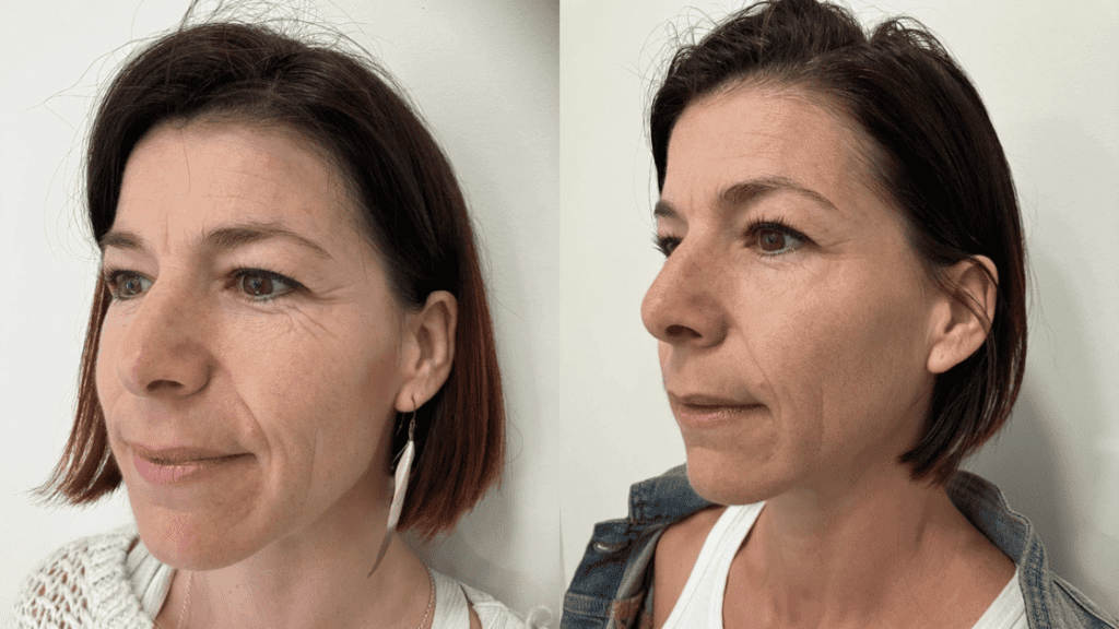 Salmon Sperm Facial: Exosomes Before and After