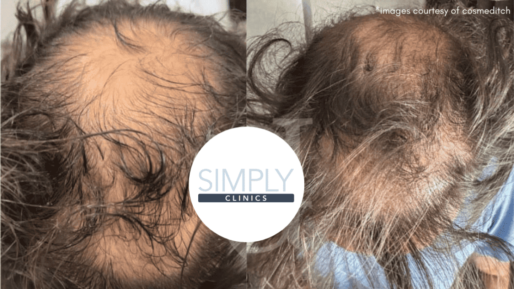 exosomes hair loss therapy before and after simply clinics