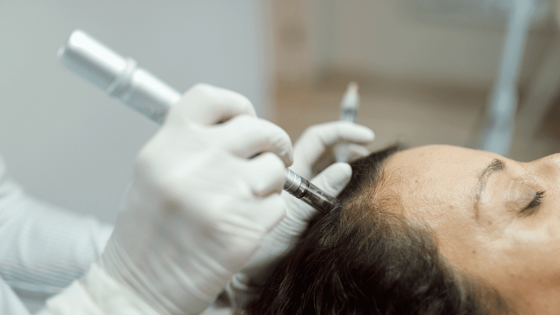 microneedling at simply clinics