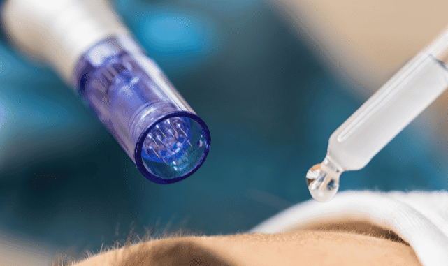 Polynucleotide Facial: Common FAQ’s about Polyneedling