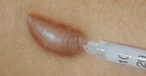 keloid scar injection treatment