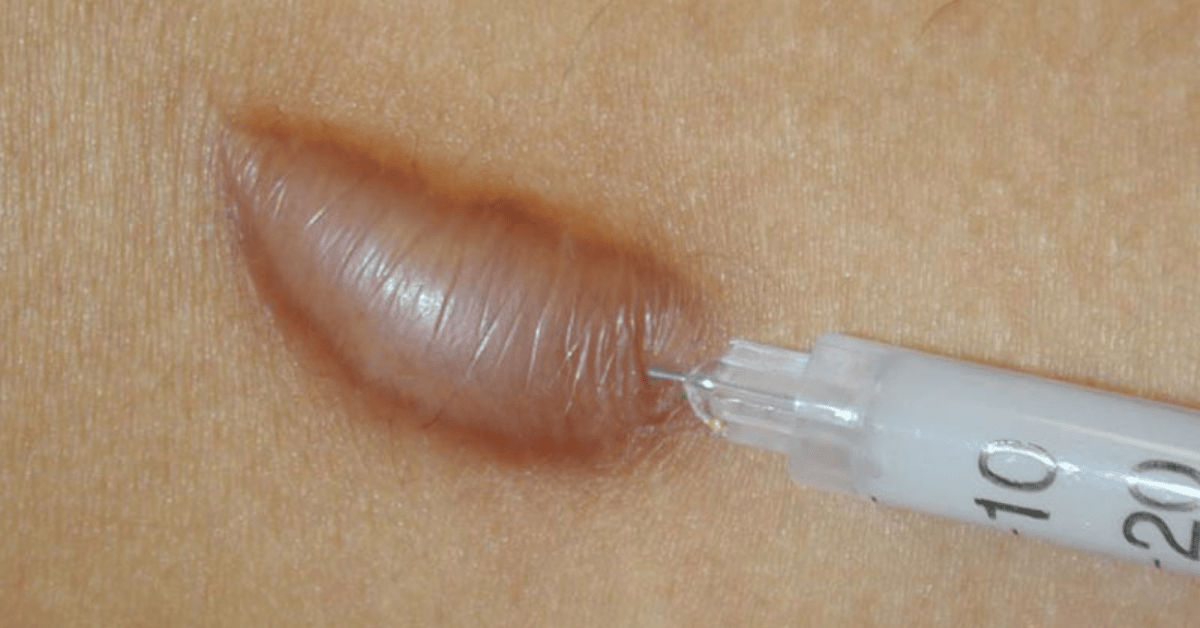 keloid scar injection
