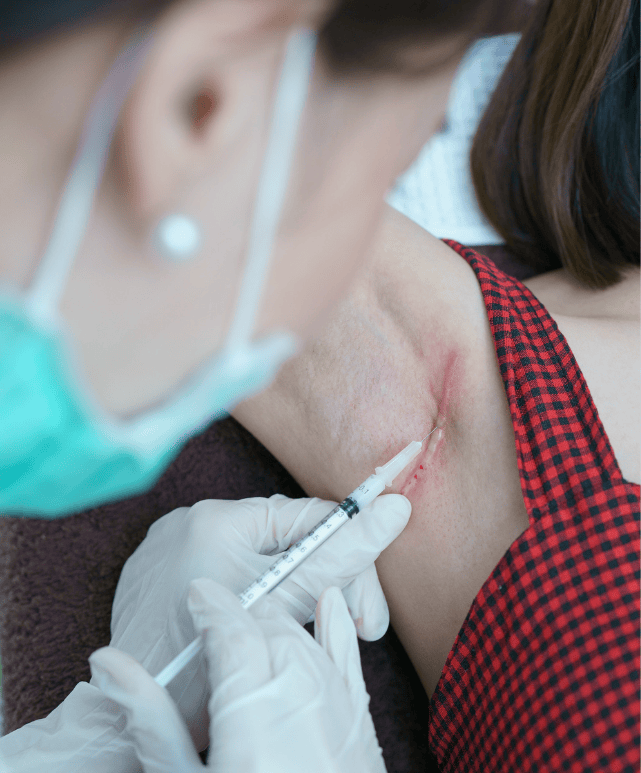 keloid scar treatment