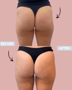 lanluma non-surgical butt lift simply clinics