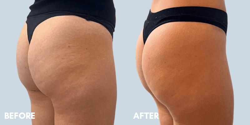 lanluma before and after simply clinics